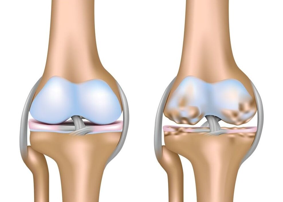 exacerbation de l'arthrose des articulations.